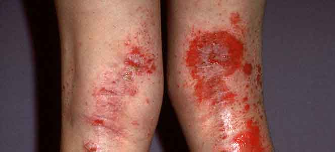 Sfondo ormonale e neurodermatitis
