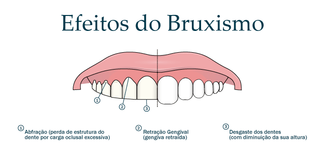 Imagens, Fotos de Bruxismo dental