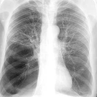 Caso clínico de RX de Enfisema pulmonar bilateral