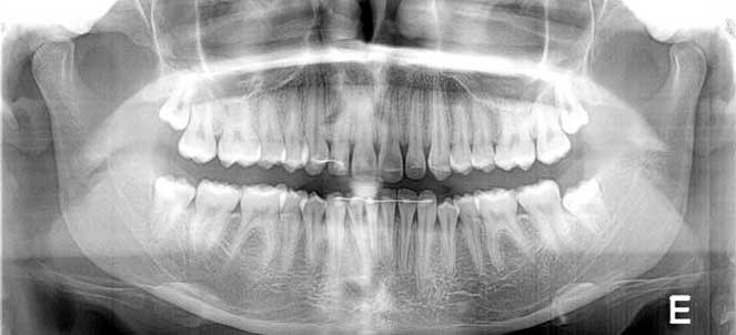 Ortopantomografia dental, fotos, imagens