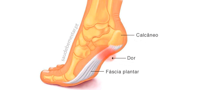 Fotos de fascite plantar