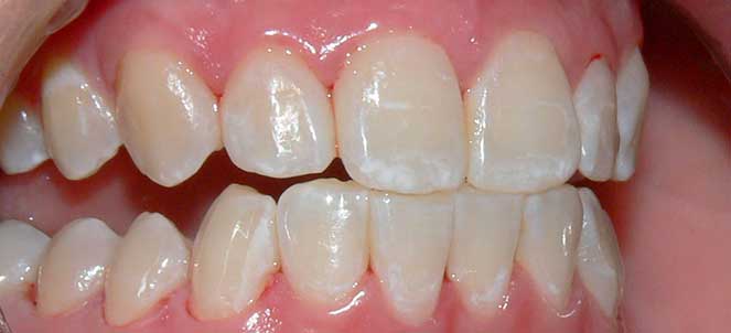 Fluorose dentária