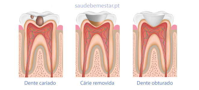 obturação dentária ou restauração de dente , fotos, imagens