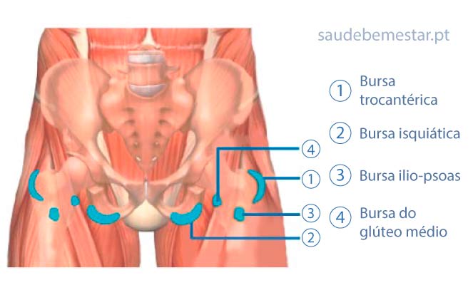Bursite da anca (ou bursite do quadril)