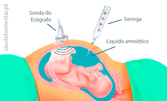 Fotos de amniocentese