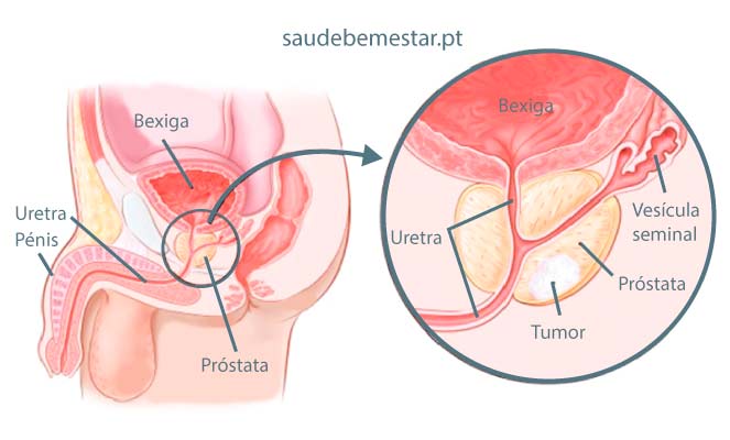 Cancro da próstata (ou cancer da próstata)