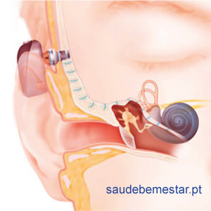 prótese auditiva ancorada no osso (Bone Anchored Hearing Aid - BAHA)