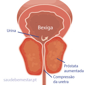 Próstata grande