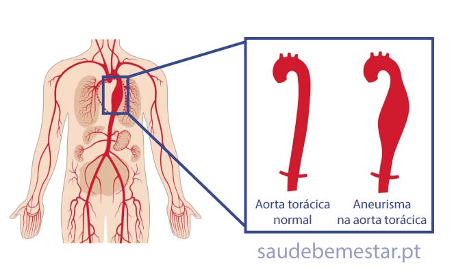 Fotos de aneurisma da aorta torácica