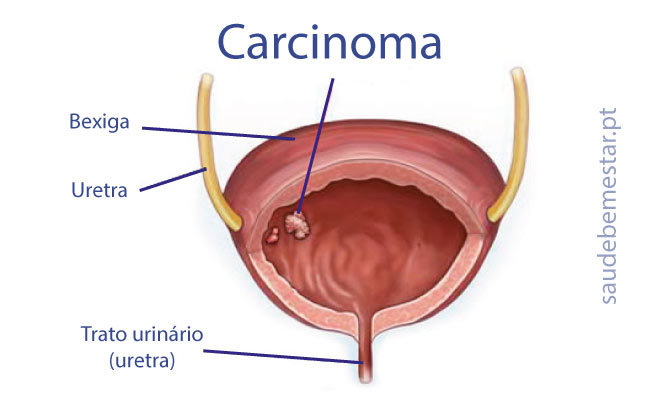 Cancro da bexiga (ou cancer da bexiga)