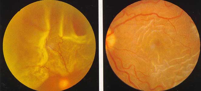 Descolamento de retina: sintomas e tratamento