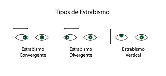 Tipos de estrabismo