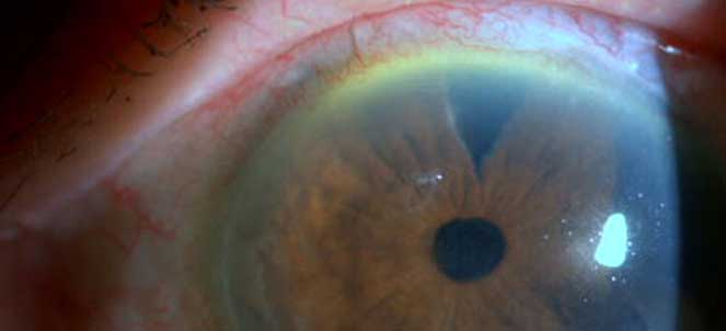 Glaucoma nos olhos fotos