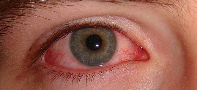 Acordou com o olho inchado, doendo levemente e com um nódulo vermelho?  Provavelmente isso que você tem é um hordéolo ou terçol, como popularmente  é, By VISIO - Clínica de Olhos