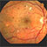 /pt/clinica/oftalmologia/retinopatia-diabetica/