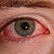 /pt/clinica/oftalmologia/olhos-vermelhos/