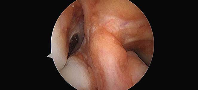 Artroscopia, a cirurgia na rotura do ligamento cruzado anterior do joelho