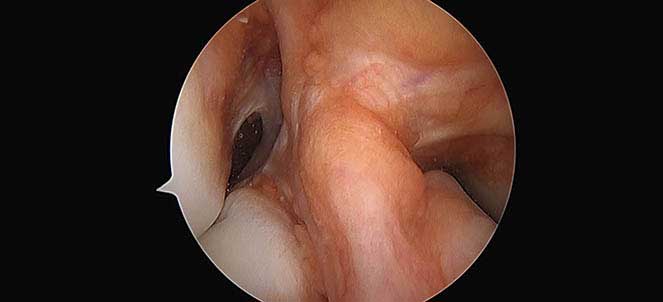 Artroscopia, a cirurgia na rotura do ligamento cruzado anterior do joelho