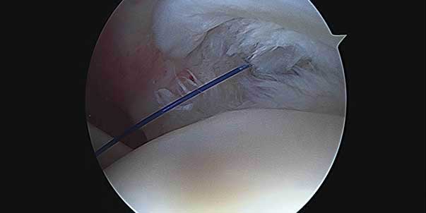 Cirurgia, o tratamento por artroscopia na rotura da coifa dos rotadores do ombro
