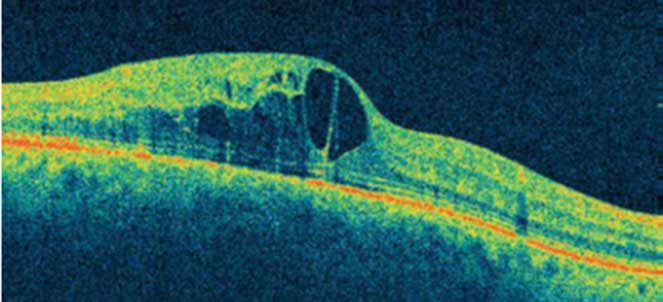 Edema macular