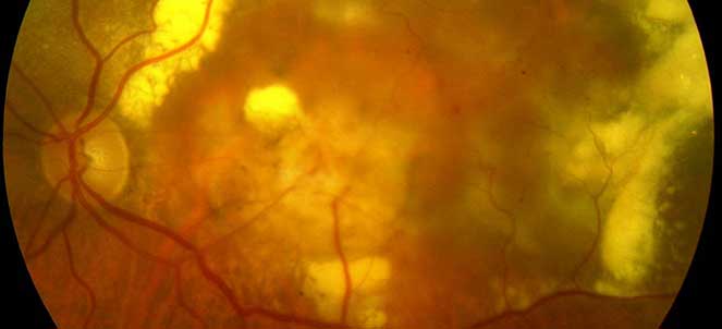 Degeneração macular - dmri, drusas maculares