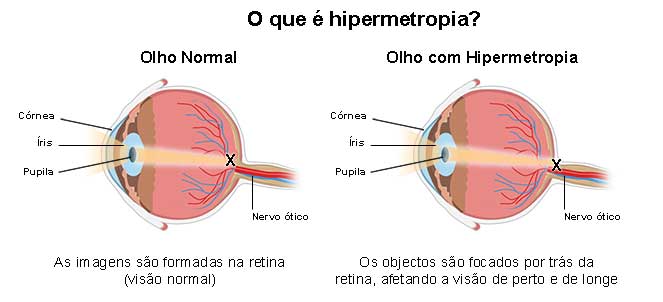 hipermetropia este atunci când este rea)