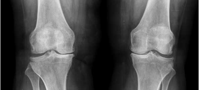 Osteoartrita - cauză, tratament și remedii | Ar trebui să știți acest lucru despre artroză.