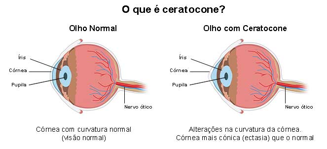 Ceratocone