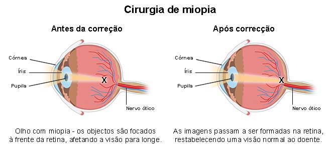 Se puede operar la miopia y el astigmatismo