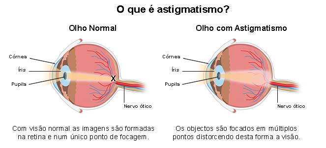 Astigmatismo fotos, astigmatismo imagens