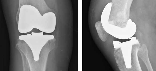 Artroplastia de joelho - cirurgia de prótese de joelho