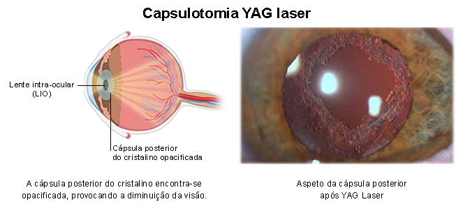 Capsulotomia Yag Laser O Que E Riscos Cuidados Preco