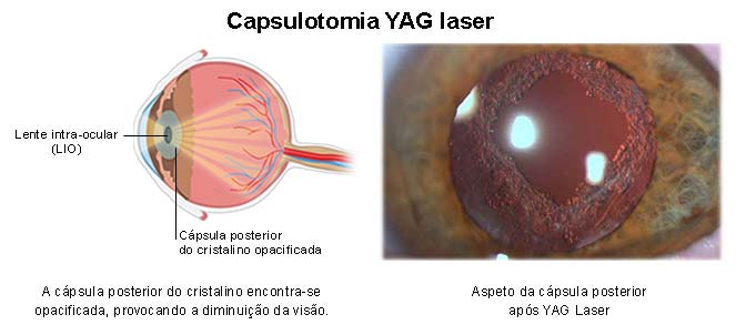 capsulotomia fotos, imagens