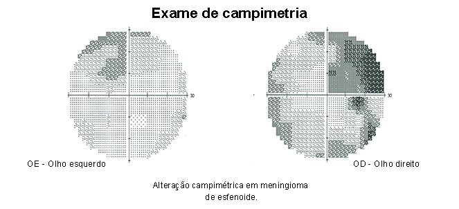 Campimetria computadorizada ou campo visual computadorizado