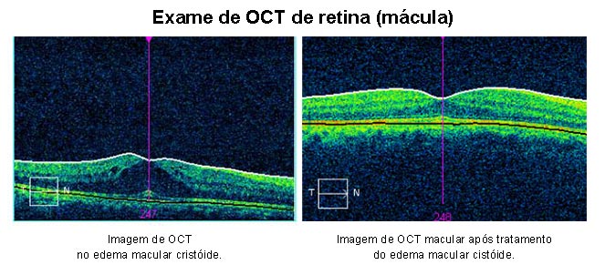 Exame de OCT macular (mácula)