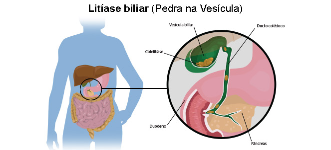 Problemas de vesicula y cansancio