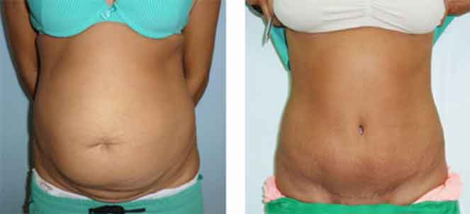 Abdominoplastia