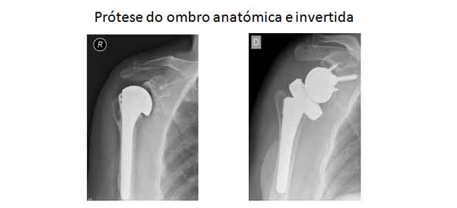 Cirurgia de ombro (prótese) - fotos, imagens
