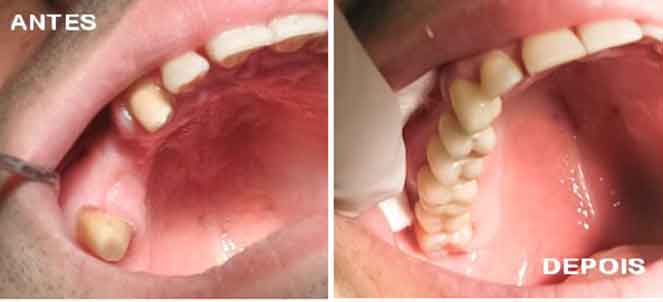 Fotos de Prótese dentária - antes e depois