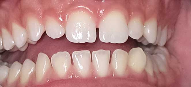 Imagens de diastema, fotos de dentes separados na frente
