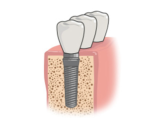Implantes dentários depois