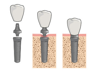 implante dentário fotos
