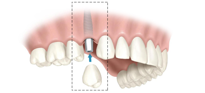 Dentes implantados fotos