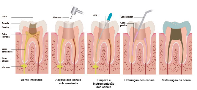 Endodontia imagens, fotos