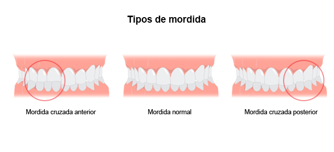 Imagens ou fotos de mordida cruzada