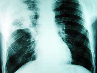 Pneumonia O Que E Causas Sintomas Tipos Tratamento Cura