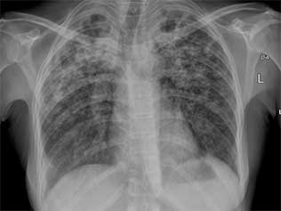 Pneumonia no pulmão esquerdo, direito