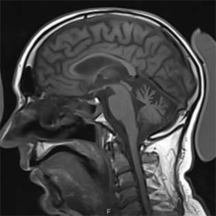 Ressonância Magnética Craniana