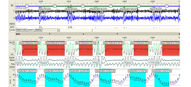 Registo poligráfico do sono noturno (Polissonografia)