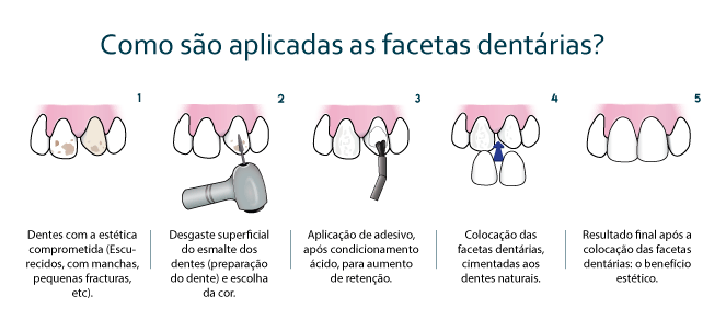 Faceta dental